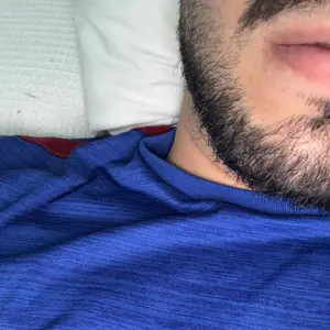 Fimose_3